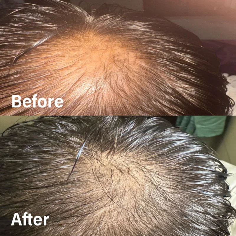 Hair growth using derma roller